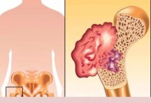 B0L U KOSTIMA, VIS0K PRITISAK I TUGA: Ovo su sigurni simptomi da vam u tijelu nedostaje ovaj VAŽAN VITAMIN! (foto)