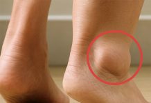 Geschwollene Füße: Was sind die Anzeichen und Lösungen