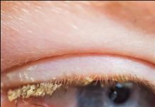 Gelbe Kruste beim Aufwachen: Was bedeutet das?