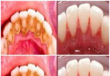 Zahnbelag selbst entfernen: Schnelles und einfaches Hausmittel