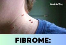 Fibrome: Das kannst du gegen die kleinen Knubbel auf der Haut tun