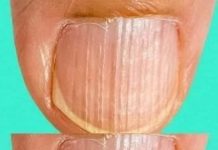 Geriffelte Fingernägel enthüllen Geheimnisse möglicher Krankheiten