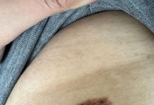 Ich habe diesen Maulwurf mit fleckigen dunklen Flecken. Was soll ich tun?