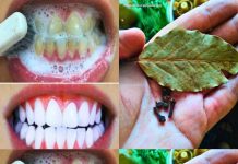 Wie kann man Zähne mit Nelken und Lorbeerblättern aufhellen