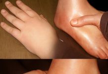 Geschwollene Hände und Füße schnell loswerden