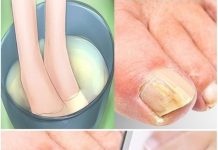 Nagelpilz mit diesen Hausmitteln beseitigen