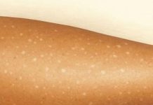 Weiße Flecken auf der Haut: Welche Vitaminmängel könnten die Ursache sein