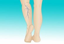 Wenn Sie violette Adern an den Beinen haben, bedeutet das, dass Sie…