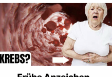 „Frühe Anzeichen von Darmkrebs, die Frauen oft ignorieren! DAS müssen Sie wissen!“