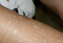 Weiße Flecken auf der Haut: Welche Vitaminmängel könnten die Ursache sein?