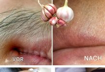 So werden Sie Gesichts- und Körperbehaarung dauerhaft los