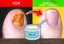 Wenn Sie Nagelpilz haben, versuchen Sie dieses natürliche Heilmittel