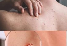 Warum haben Sie rote Muttermale auf Ihrer Haut? Das ist der Grund!!