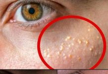 Kleine weiße Knötchen im Gesicht? Hier erfährst du, was sie sind – und wie du Milien auf natürliche und sichere Weise zu Hause behandeln kannst.