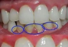 Entfernen Sie Zahnbelag in 5 Minuten auf natürliche Weise – ganz ohne Zahnarztbesuch