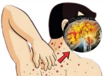 Fettlebererkrankung (Steatose): Ursachen, Symptome, Behandlung und Hausmittel
