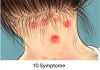 10 Symptome von Fibromyalgie, die jeder mit Muskelschmerzen lesen sollte