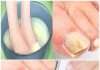 Nagelpilz mit diesen Hausmitteln beseitigen