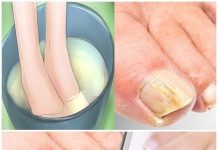 Nagelpilz mit diesen Hausmitteln beseitigen