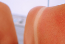 Der einfachste Trick gegen Sonnenbrand: Tragen Sie diese Pflanze auf und vergessen Sie Schmerzen und Rötungen!!!!