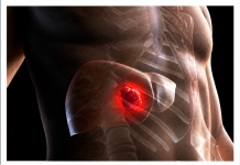 LEBERKREBS HAT SEHR ERKENNBARE SYMPTOME – SIE DÜRFEN SIE NICHT ÜBERSEHEN: Das sind die 4 Entwicklungsstadien dieses tückischen Tumors!
